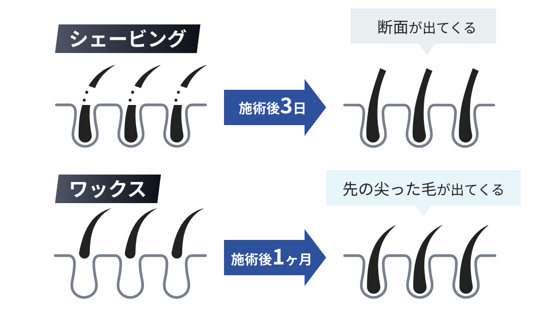 ワックス・・・施術後１ヶ月後に尖った毛が出てくる。シェービング・・・施術三日後に断面が出てくる。